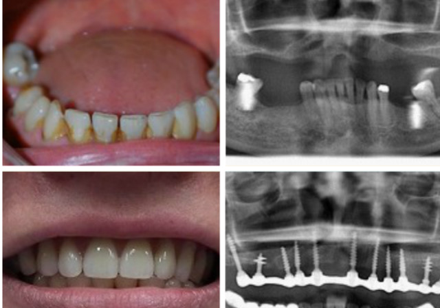 种植牙修复案例