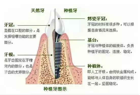 缺牙的修复方式 哪个更值得拥有