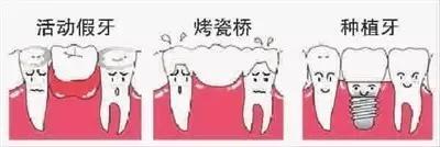 缺牙的修复方式 哪个更值得拥有