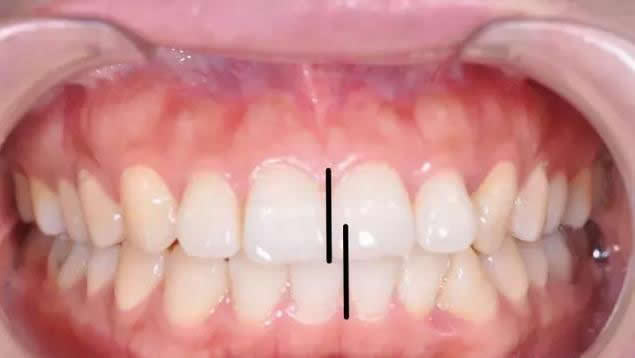 牙套故事 | 跨越2/3个中国，嘴突少女戴完牙套变网红