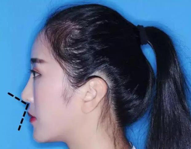 牙套故事 | 跨越2/3个中国，嘴突少女戴完牙套变网红