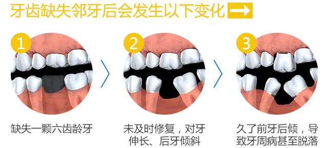 极光口腔种植牙